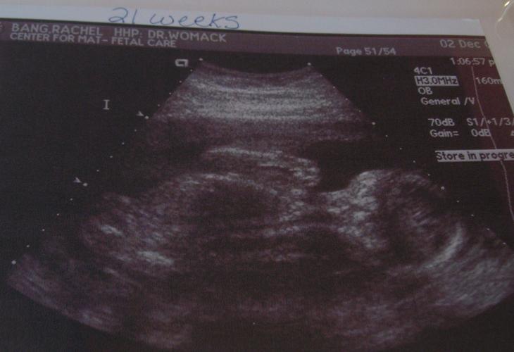 Nathan ultrasound